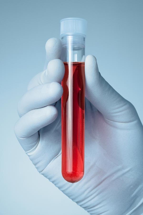 Autoimmune-Treatment Close up of a gloved hand holding a vial of red liquid, representing AZENA Health & Longevity's comprehensive autoimmune disorder treatment in Gainesville.