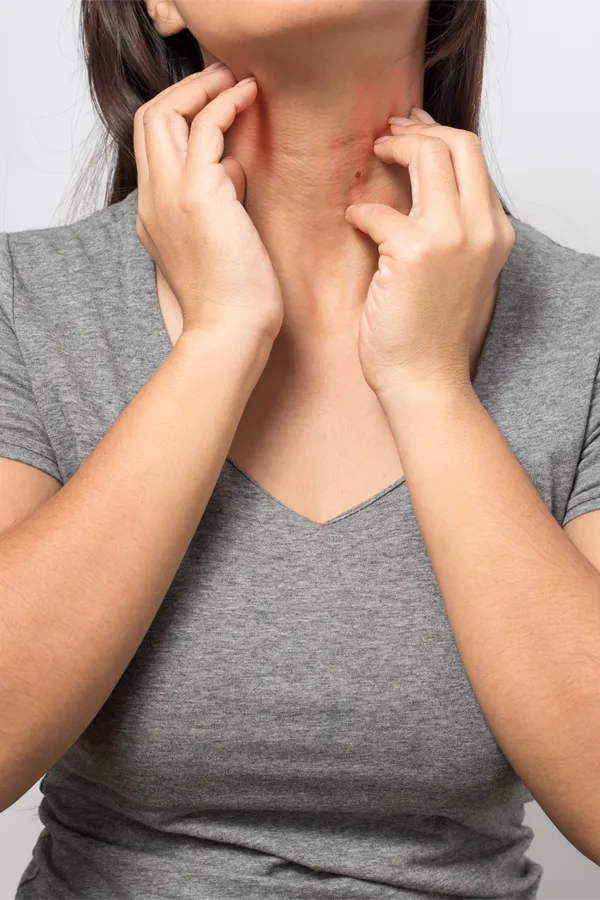 Hives-Treatment A woman with brown hair and a gray shirt scratches irritated areas on her neck due to hives. Get care for hives from AZENA Health & Longevity in Gainesville.